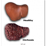 cirrhosis-liver.png