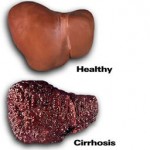 cirrhosis-liver-8×6.jpg